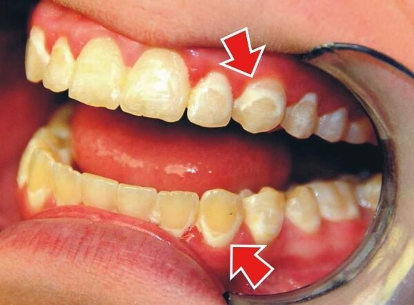 Пятна на зубах после снятия брекетов